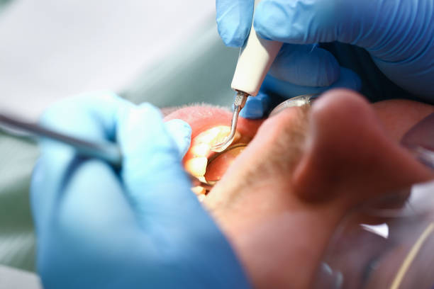 Best Broken or Chipped Tooth Repair in Springdale, OH