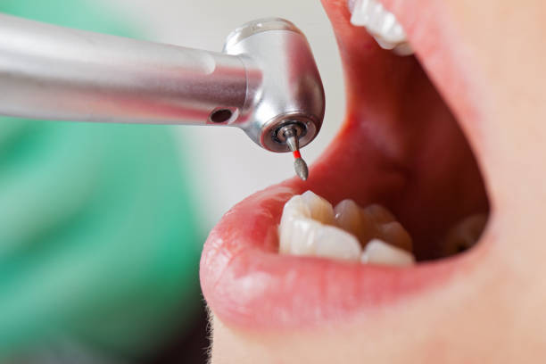 Best Walk-In Emergency Dental Services in Springdale, OH